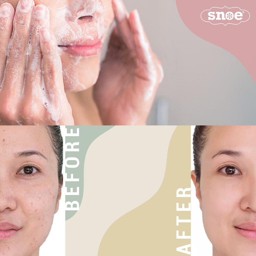 A woman's face is shown before and after using SHOO-ZIT DON'T BOTHER ME Outzit Natural Acne Drying Beauty Soap, showcasing the transformative effects of this beauty product.